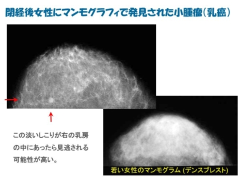 閉経後女性の乳房内に見つかった小さな乳癌