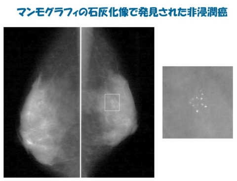 マンモグラフィの石灰化像で発見された非浸潤癌 1